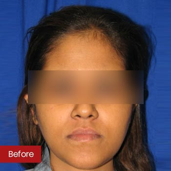 Prof. Dr. Mohan Thomas Rhinoplasty