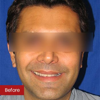 Prof. Dr. Mohan Thomas Rhinoplasty