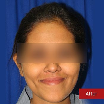 Prof. Dr. Mohan Thomas Rhinoplasty