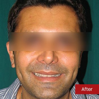 Prof. Dr. Mohan Thomas Rhinoplasty