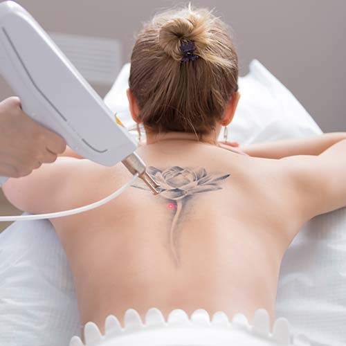 Laser Tattoo Removal