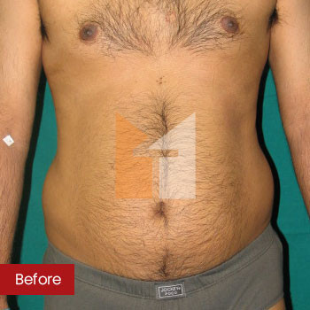 Six Pack Abs Surgery Mumbai  Six Packs Treatment Cost India