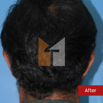 Prof. Dr. Mohan Thomas Rhinoplasty